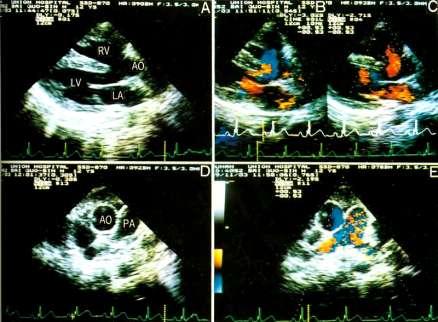 Echocardiography The aorta widen and override on the