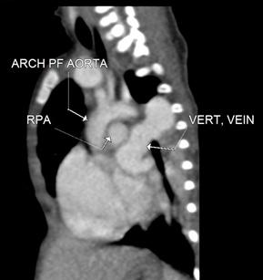 segment narrowing seen involving arch of aorta distal to left subclavian