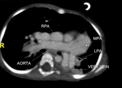 inferior pulmonary veins draining into the vertical vein ( blue arrow)seen