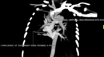 tortuous supracardiac vertical vein, via a vascular