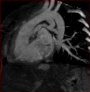 artery arising from the left ventricle Figure