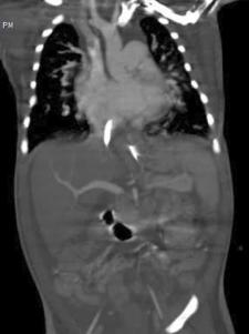 Axial MPR imaging depicting aorto-pulmonary