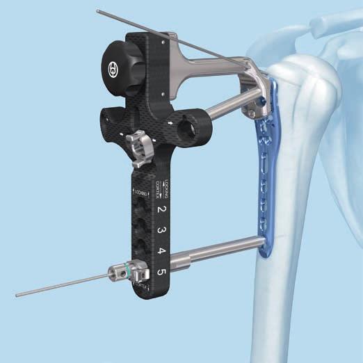 Implantation 6 Determine proximal screw lengths Instruments 03.113.009 Outer Sleeve for percutaneous LCP Aiming Instruments 3.5 03.113.022 Centering Sleeve, percutaneous, for Kirschner Wire B 1.