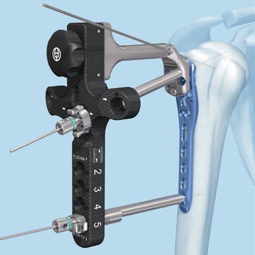 Since it may not always be possible to feel the resistance from the subchondral bone, and the drill bit represents the final position of the locking screw, the use of image intensification is