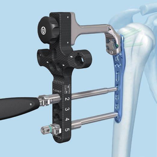 Implantation Precaution: To ensure plate-device alignment, the aiming arm must be locked to the plate on both ends during screw insertion.