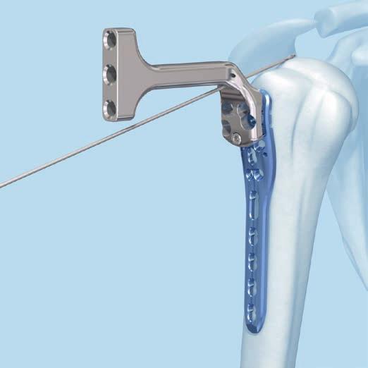 2 Prepare plate position Note: The LCP Percutaneous Aiming System 3.5 for PHILOS is used with the PHILOS plate.