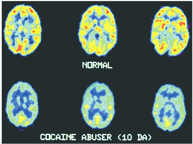The addicted brain! Learning, culture, and addiction! Addiction patterns vary according to cultural practices and the social environment.