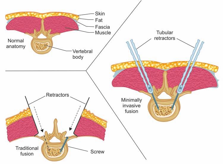 Percutaneous Posterior Fixation: A Unique Entity to minimize Further Damage to Patient with Traumatic Spine A C B Figs 1A and B: Open vs minimally invasive surgery technique for pedicle screw