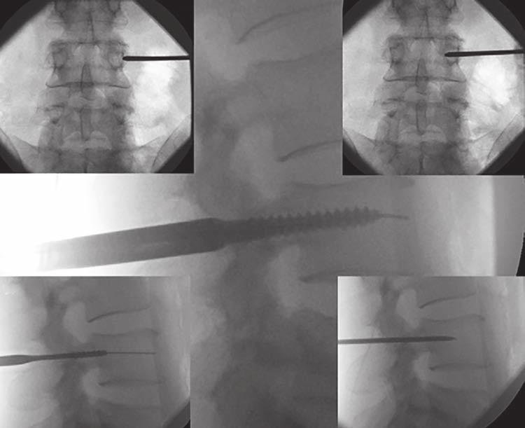 Kaushal R Patel et al Fig. 4: The IITV images depicting Jamshidi needle, K-wire insertion and tapping angled appropriately.