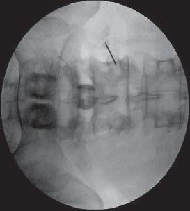 The needle is positioned on the paraspinal fascia directly over the pedicle on an AP image.