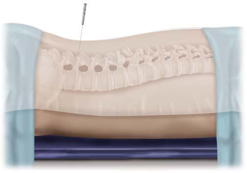 The fascial incision is slightly lateral to the pedicle on fluoroscopy.