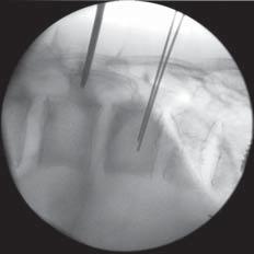 AP and lateral fluoroscopy should be used intermittently as needed to confirm direction. An AP image should show the needle tip initially at the lateral margin of the pedicle.
