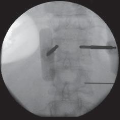 Helpful Tip If the needle within the medial wall of the pedicle at the base and trocar has an oblique trajectory into the body, it may appear medial to the pedicle wall due to the oblique trajectory