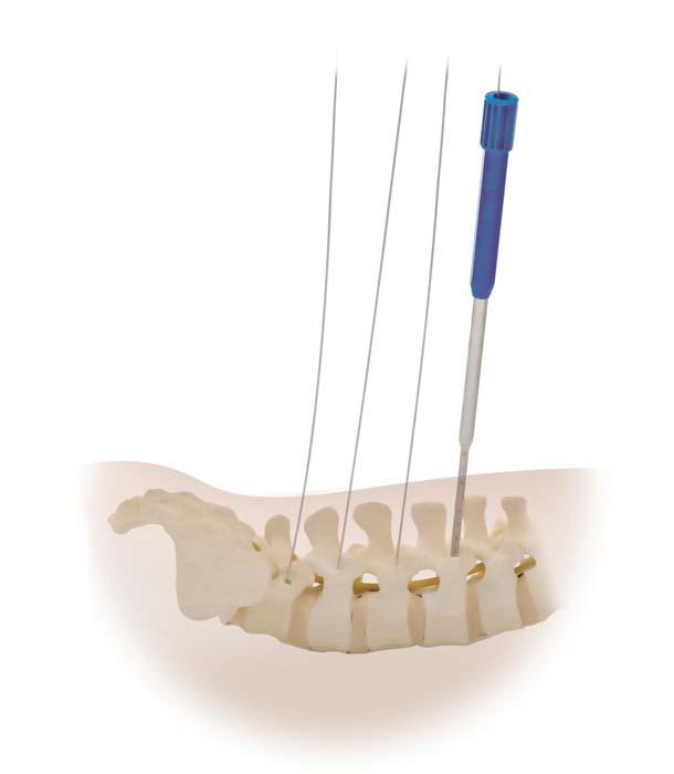 18 CD HORIZON LONGITUDE II Multi-level Percutaneous Fixation System SURGICAL TECHNIQUE Dilation The fascia and muscle must be dilated to allow for screw placement.