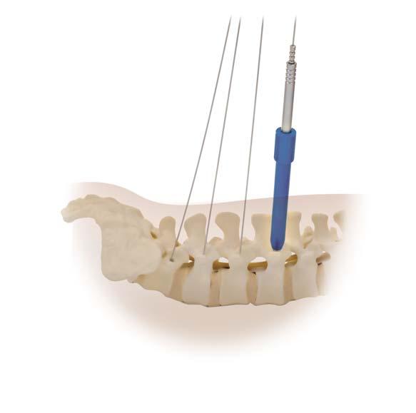 Dilators should dock on bony anatomy to minimise tissue creepage (Figure 17).