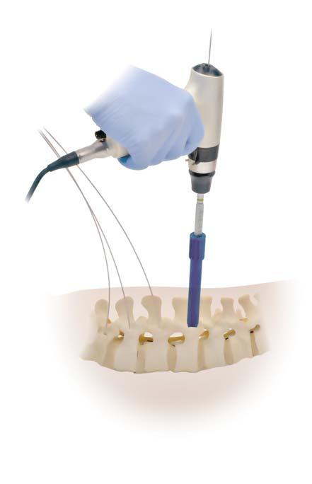 CD HORIZON LONGITUDE II Multi-level Percutaneous Fixation System SURGICAL TECHNIQUE 19 Pedicle Preparation The pedicle is prepared by placing the Tap over the Guidewire and through the third dilation
