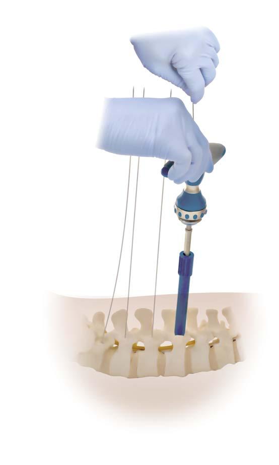 20 CD HORIZON LONGITUDE II Multi-level Percutaneous Fixation System SURGICAL TECHNIQUE Pedicle Preparation continued Tap Removal Hold the Guidewire firmly when removing the Tap and exercise great