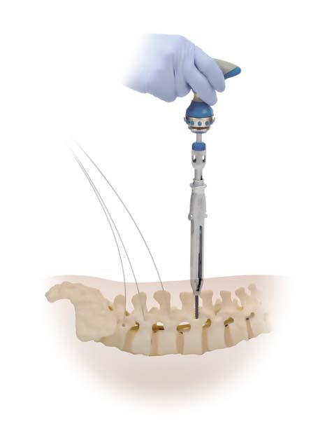 24 CD HORIZON LONGITUDE II Multi-level Percutaneous Fixation System SURGICAL TECHNIQUE Screw Insertion Care should be used to avoid inadvertent Guidewire removal prior to screw placement.