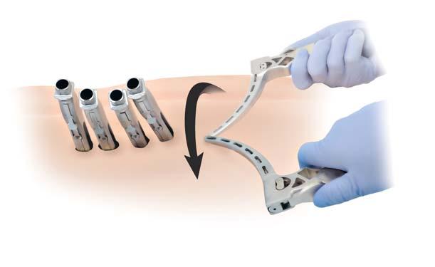 using tactile feel, AP and lateral fluoroscopy images, the Rod Confirmation Tool, and the Extender rotation technique as necessary