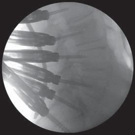 For example, a coronal bend may initially be placed in the Rod.