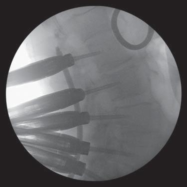 CD HORIZON LONGITUDE II Multi-level Percutaneous Fixation System SURGICAL TECHNIQUE 33 Rod Passage continued Confirm Rod Overhang With the rod confirmed through all of the Extenders, use lateral