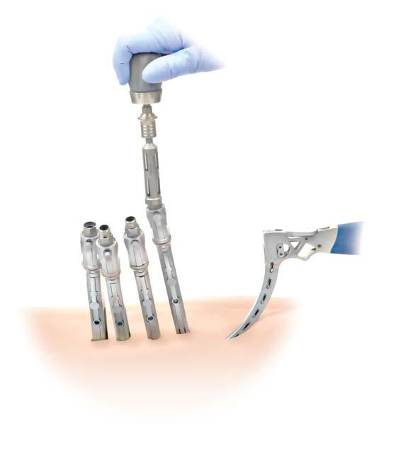 34 CD HORIZON LONGITUDE II Multi-level Percutaneous Fixation System SURGICAL TECHNIQUE Rod Reduction Reducing the Rod in Stages To attach the Rod Reducer to the Screw Extender, slide the reducer into
