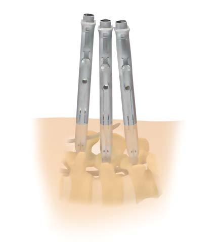 CD HORIZON LONGITUDE II Multi-level Percutaneous Fixation System SURGICAL TECHNIQUE 37 Alternate Rod Insertion Method continued Rod Passage After the rod is through the first Extender, guide it via