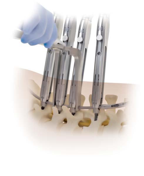 CD HORIZON LONGITUDE II Multi-level Percutaneous Fixation System SURGICAL TECHNIQUE 41 Compression/Distraction To compress, loosen the set screw from