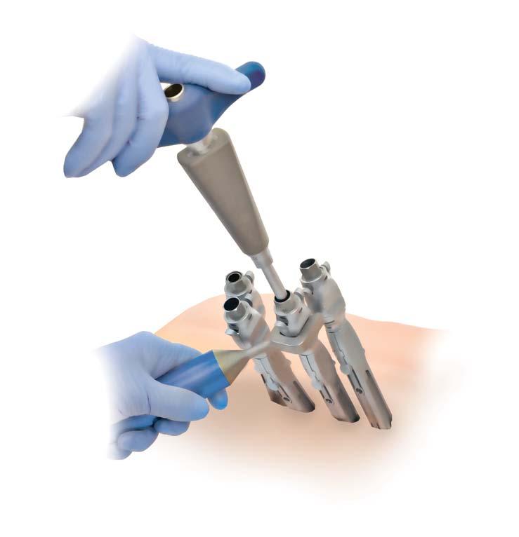 CD HORIZON LONGITUDE II Multi-level Percutaneous Fixation System SURGICAL TECHNIQUE 43 Set Screw Break-off Once compression/distraction is complete, use the Counter Torque on the Extender and