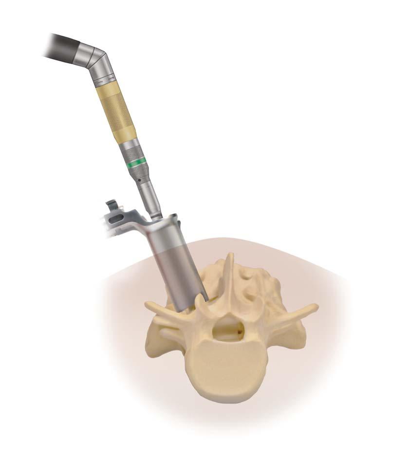 CD HORIZON LONGITUDE II Multi-level Percutaneous Fixation System SURGICAL TECHNIQUE 47 Facet Fusion continued Decortication and Bone Graft Placement Use cautery to expose the articulation between the