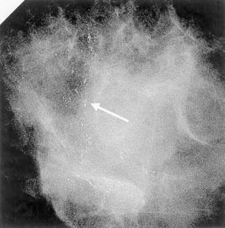 Stereotactic biopsy was performed with a dedicated table with digital imaging capabilities (StereoGuide with Digital Spot Mammography; LoRad, Danbury, US) [Fig 1].