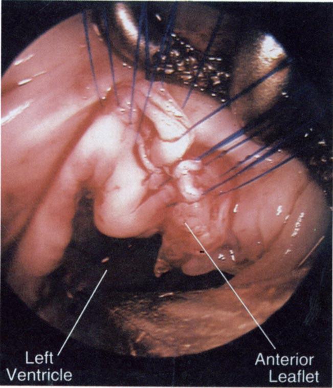 866 BURKE ET AL Ann Thorac Surg 1994;58:864-8 Fig 1. (Patient 1.) Rigllt atrial exposure of the ucniricular with the nidcoscopc advanced through the conoocniriculardefect into the left ventricle.
