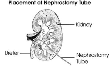 Problems to report to the doctor If your nephrostomy tube falls out, call your urologist or go to a hospital Emergency Department immediately to have the tube replaced.