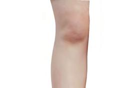 (The tibial nerve and popliteal artery run below this acupoint.