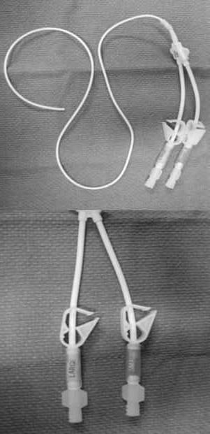 Tunneled Catheters such as Hickman and Broviac Catheter A tunneled external catheter Single or dual