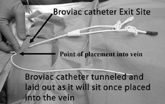 Broviac or Hickman Catheters Insertion of Hickman A