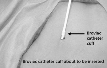 vein In this diagram, the catheter goes into subclavian