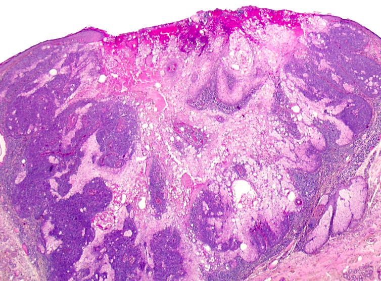 High frequency and diversity of cutaneous appendageal tumors in organ transplant recipients Harwood C et al.
