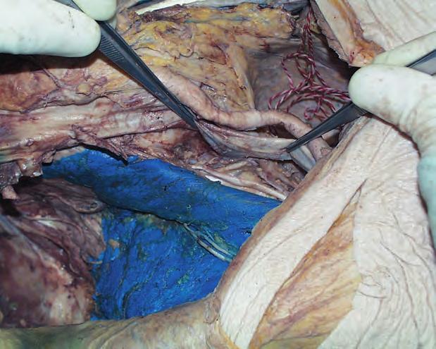 124 Lower Limb 1 2 3 4 Fig. 9.28 Dye introduced through a correct access to the femoral nerve block (before dissection) does not reach the obturator nerve.