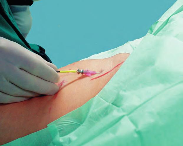 If the response is lost, it can be useful to direct the needle tip somewhat anteriorly by lowering the hub of the needle.