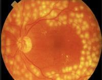 changes RETINAL TEARS CARBON DIOXIDE ( CO2) LASER Seals retinal