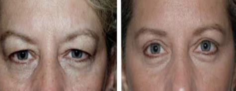 BROW PTOSIS/BLEPHAROPLASTY LID AND FACIAL SURGERY