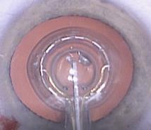 CONS OF LASER ASSISTED PHACO ZEPTO CAPSULORRHEXIS DEVICE Corneal docking can be difficult in certain patients High speed energy system delivers electrical impulses to lens capsule Not useful in small