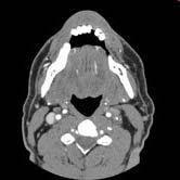 CT angio neck (neurology workup): 6.