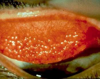 Atopic Keratoconjunctivitis (AKC) Associated with atopic dermatitis May be perennial Genetic