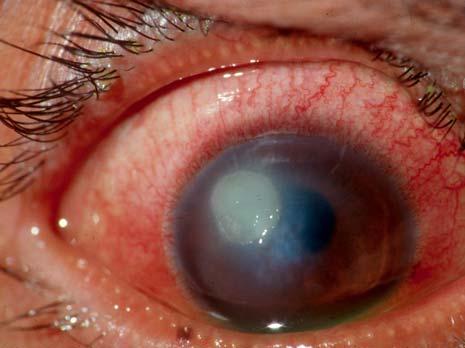 Elevated levels of eosinophils, TH 2 lymphocytes, and mast cells Itching Redness Photophobia Keratopathy