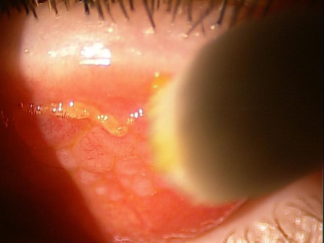 Giant Papillary Conjunctivitis (GPC) Repeated