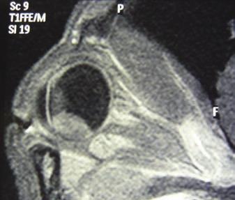 Investigations continued with magnetic resonance imaging and fine needle aspirates performed under general anaesthesia. intraocular mass. Intraocular melanoma was considered (Figure 6).