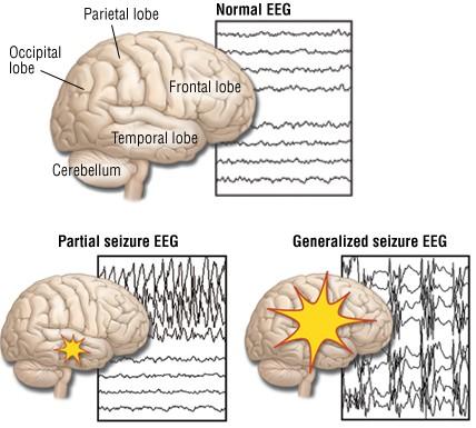 Seizures Partial Seizure Start in a focal area Generalized Seizures Involve entire brain at outset Always