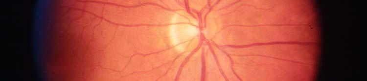 spot with normal peripapillary retina Ring scotomas Photopsias Diffuse